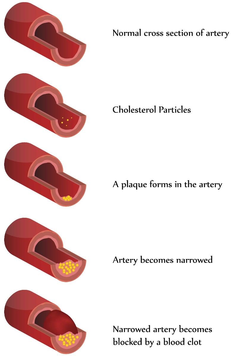 atherosclerosis process diagram