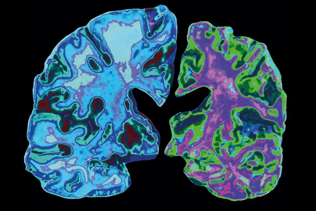 Senescence and the search for anti-aging senolytics for Alzheimer’s disease