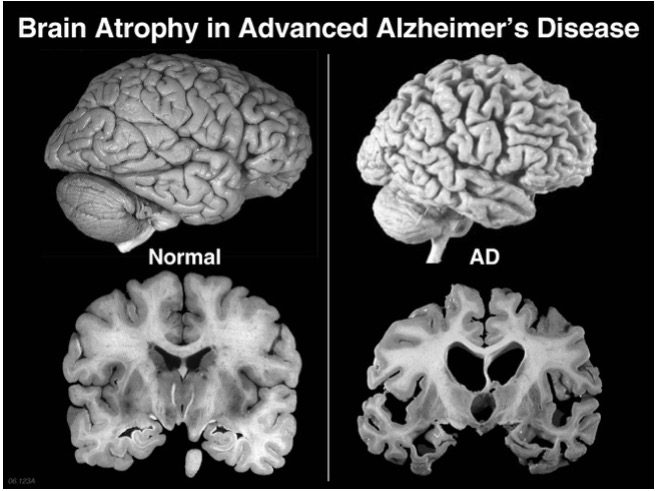 brain atrophy in alzheimer's disease post-mortem autopsy